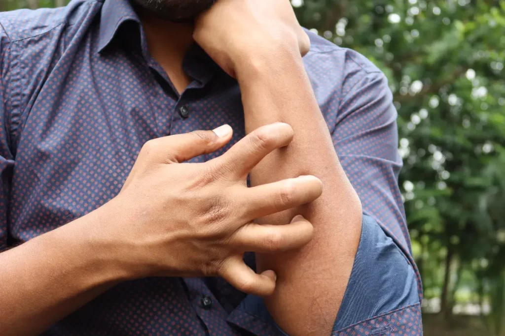 Journée mondiale de l'eczéma atopique