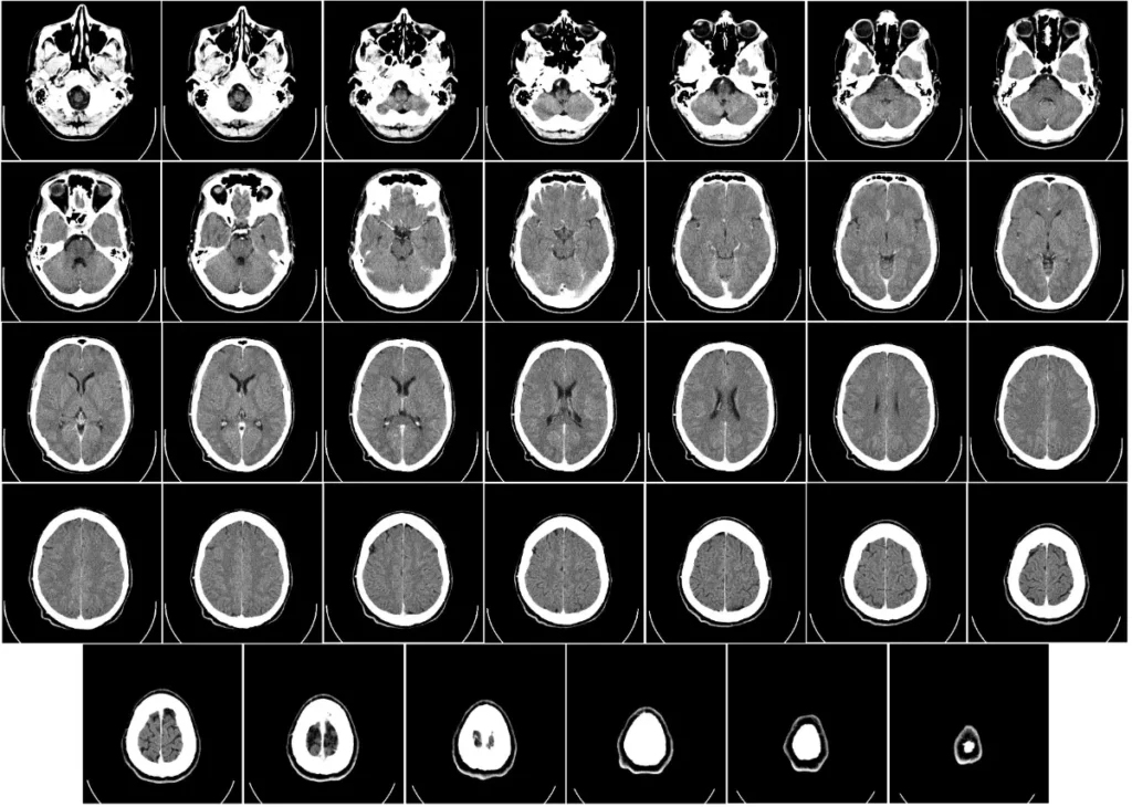 Journée mondiale de la maladie d'Alzheimer