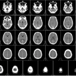 Journée mondiale de la maladie d'Alzheimer