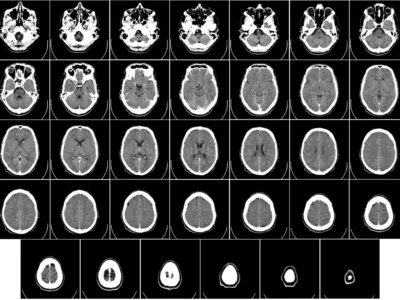 Journée mondiale de la maladie d'Alzheimer
